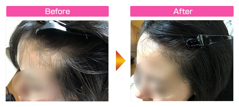 【発毛】30代女性のビフォーアフター②