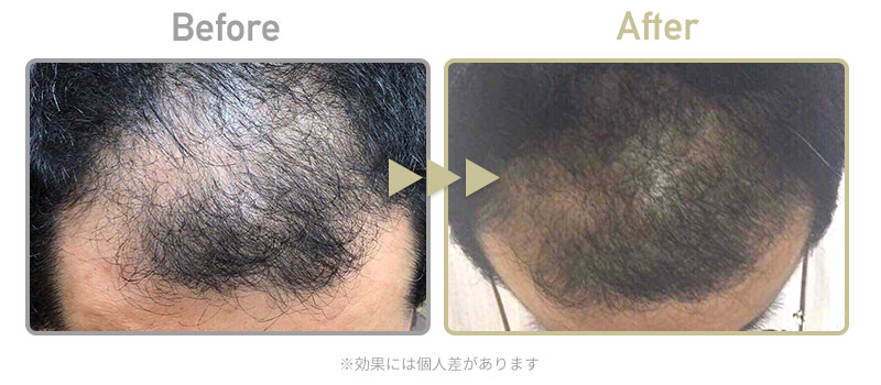 【発毛】ビフォーアフター画像